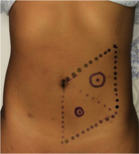 Lugar exacto donde realizar una colostomía