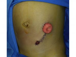 colostomia3