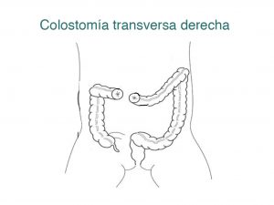 colostomia-transversa-derecha