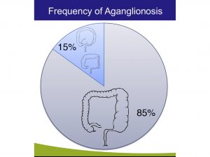 frecuencia-de-aganglionosis