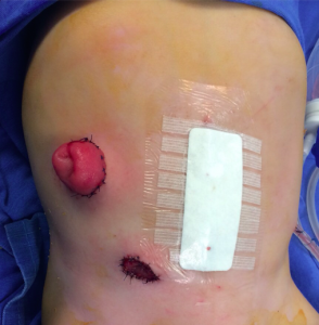 Derivación intestinal recomendada en pacientes con enfermedad de Hirschsprung